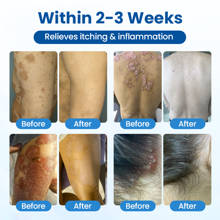 Eczema, Psoriasis & Skin Tags Gone Naturally with TAILEDEN®