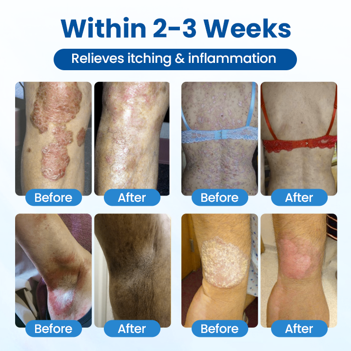 Eczema, Psoriasis & Skin Tags Gone Naturally with TAILEDEN®