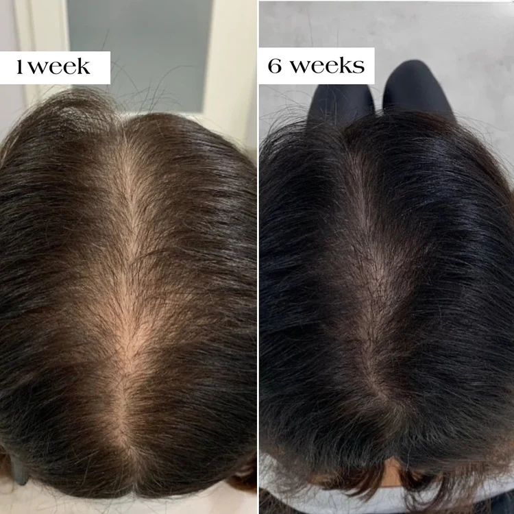 Nexisify shampoo results after 4 to 6 weeks